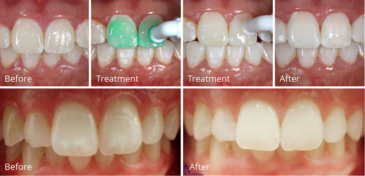 Icon Resin Infiltration 